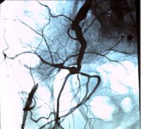 Iliac artery stenting