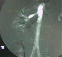 Renal Angioplasty Renal Angioplasty
