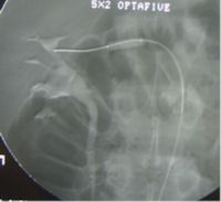 Renal Angioplasty Renal Angioplasty