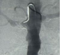 Renal Artery Stenting