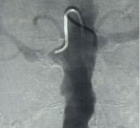 Renal Artery Stenting Renal Artery Stenting
