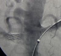 Renal Artery Stenting Renal Artery Stenting