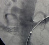 Renal Artery Stenting