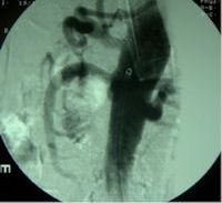 Celiac and SMA stents Celiac and SMA stents